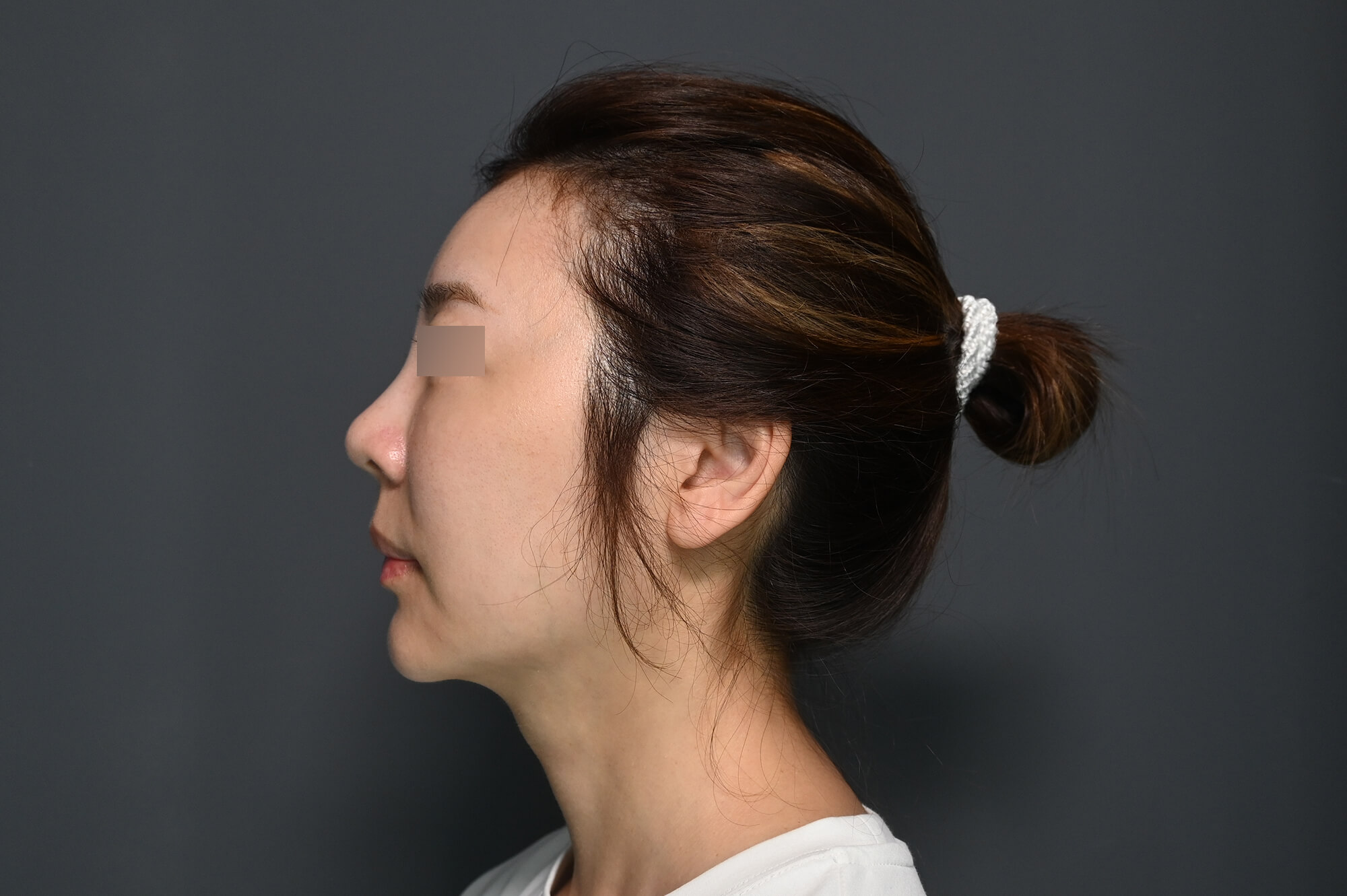 【海芙電音雙波】療程前Before-小嫚